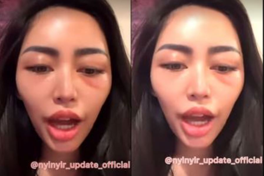 Kondisi Mata Rachel Vennya Jadi Sorotan